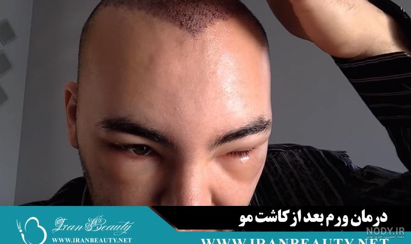 مزایا و معایب کاشت مو مزایا و معایب کاشت مو