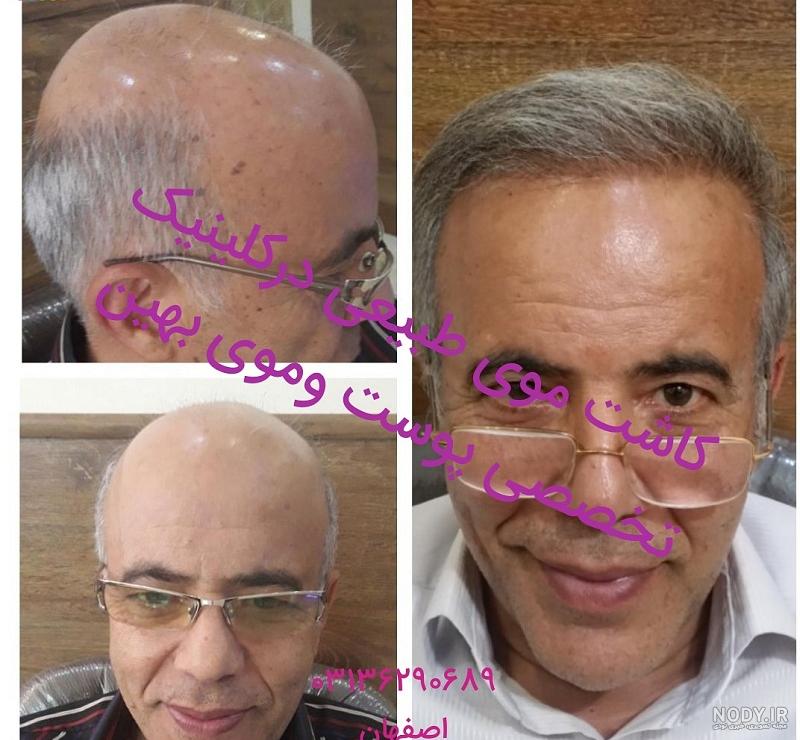 نتیجه کاشت مو بعد از سه ماه نتیجه کاشت مو بعد از سه ماه