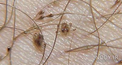 درمان شپش درمان شپش