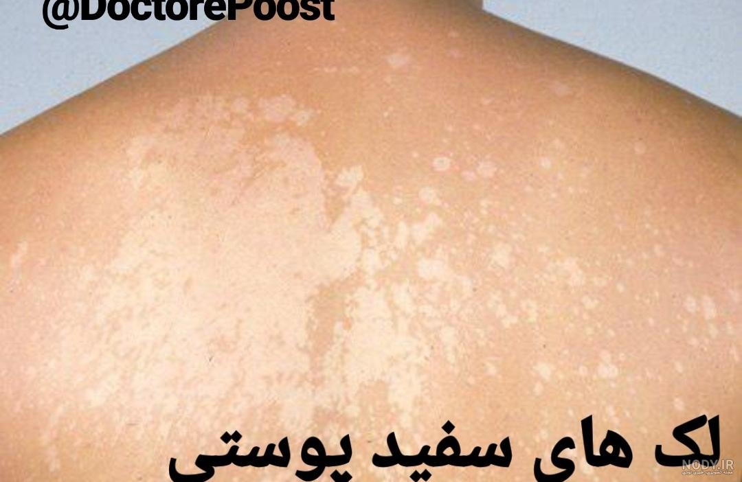 لکه های سفید روی پوست بر اثر آفتاب لکه های سفید روی پوست بر اثر آفتاب