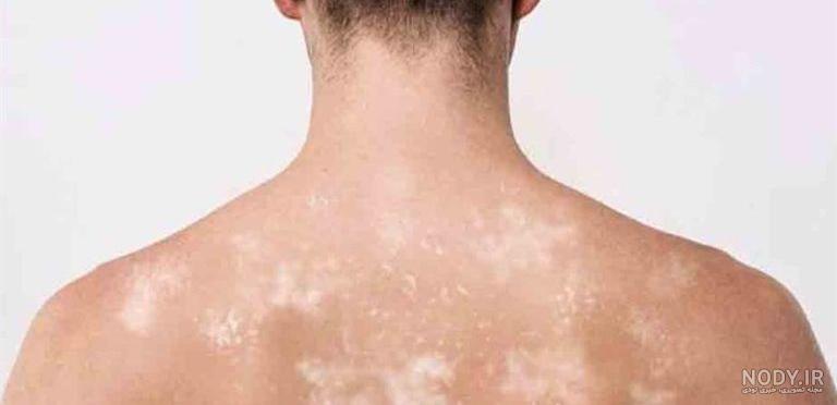 پماد کلوتریمازول برای لک صورت نی نی سایت پماد کلوتریمازول برای لک صورت نی نی سایت