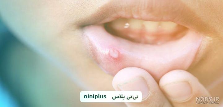 برفک دهان نی نی سایت برفک دهان نی نی سایت