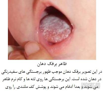 جوش سقف دهان نشانه چیست جوش سقف دهان نشانه چیست