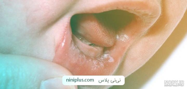 جوش سقف دهان نوزاد نی نی سایت جوش سقف دهان نوزاد نی نی سایت