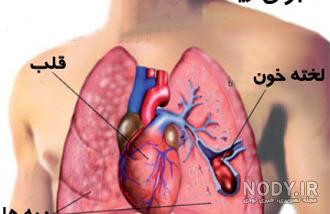 داروی آمبولی ریه داروی آمبولی ریه
