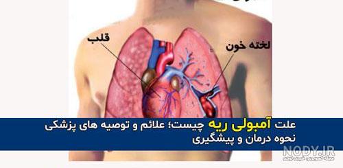 درمان آمبولی ریه در طب سنتی درمان آمبولی ریه در طب سنتی