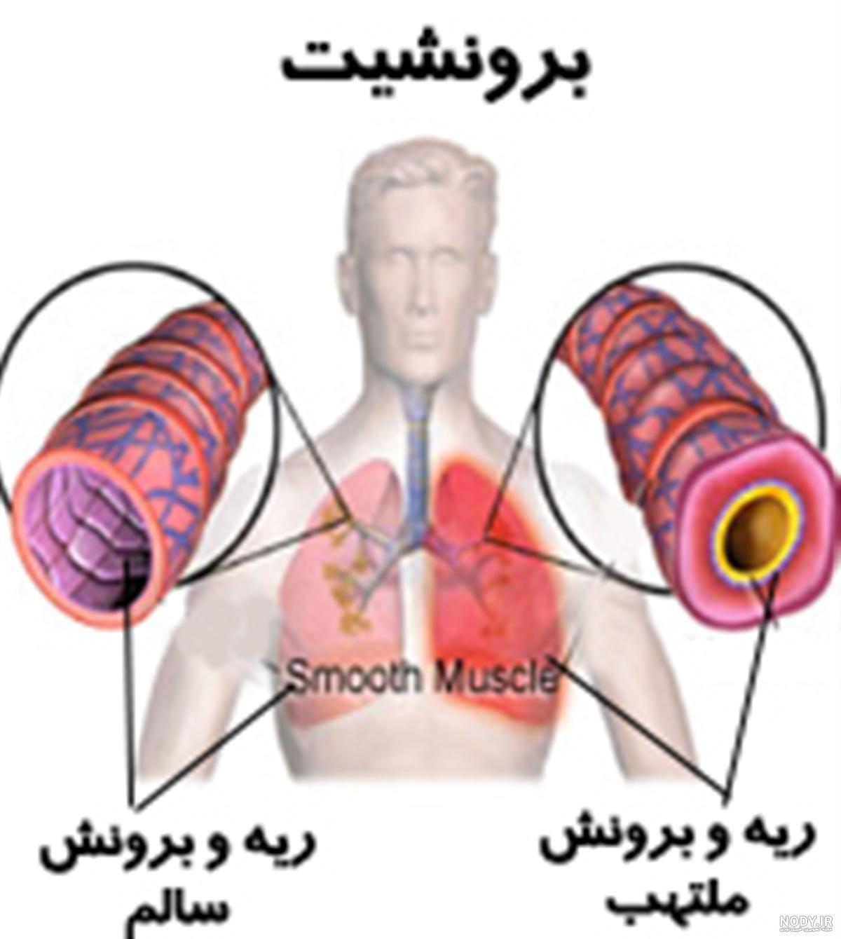 عکس ریه برونشیت