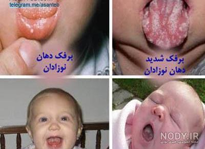 فلوکونازول برای برفک دهان نوزاد نی نی سایت فلوکونازول برای برفک دهان نوزاد نی نی سایت