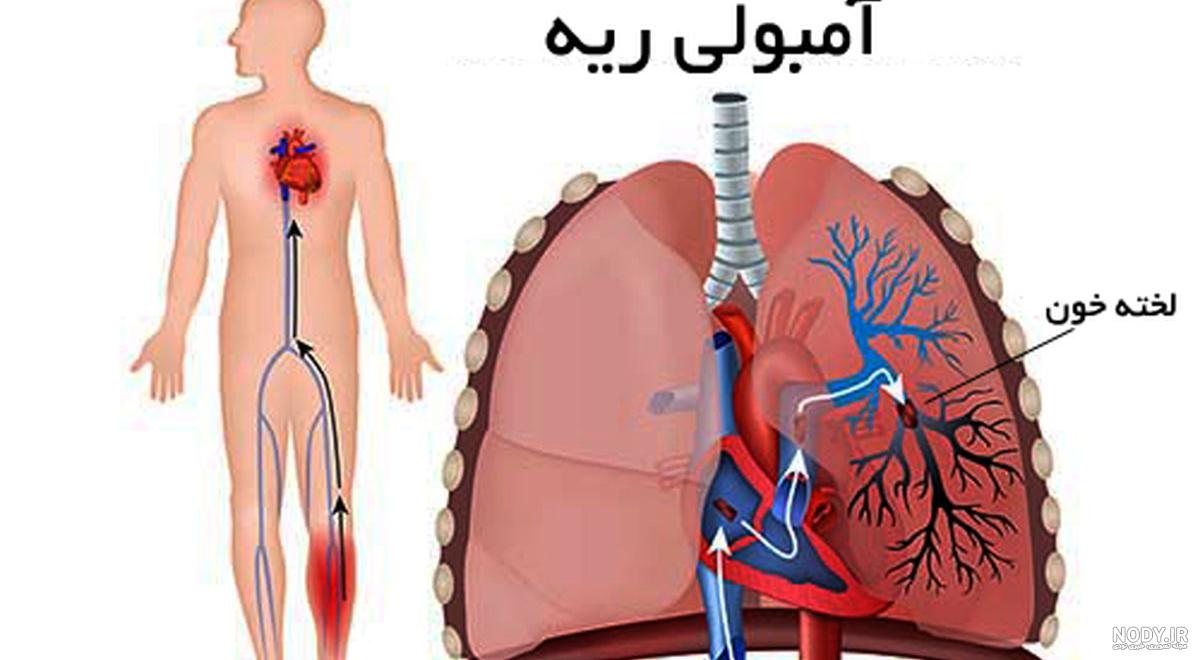 میزان خطر آمبولی ریه میزان خطر آمبولی ریه