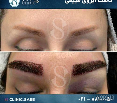 بعد از کاشت ابرو چه اتفاقی می افتد بعد از کاشت ابرو چه اتفاقی می افتد
