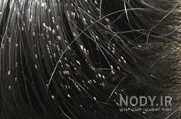 درمان شپش سر با روغن زیتون درمان شپش سر با روغن زیتون