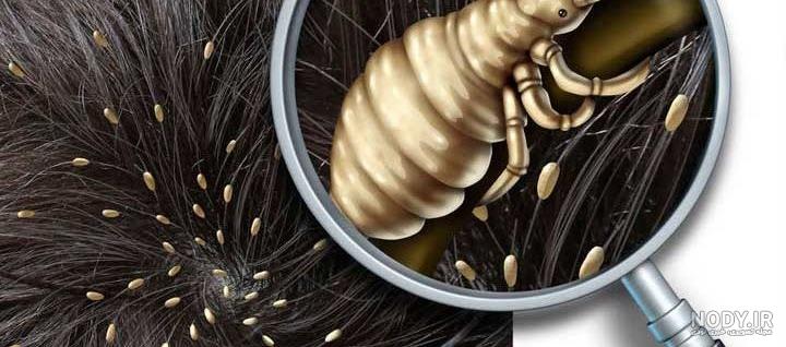 شپش چیست و چگونه منتقل میشود