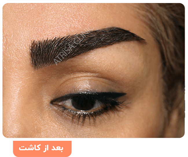 علت سیخ شدن ابرو بعد از کاشت علت سیخ شدن ابرو بعد از کاشت