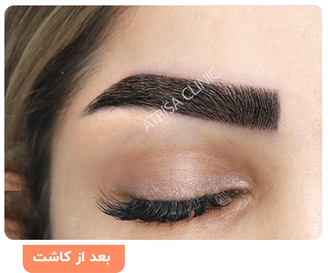 عوارض کاشت ابرو عوارض کاشت ابرو