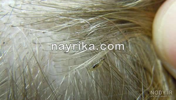 عکس شپش نابالغ