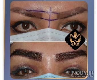 عکس کاشت ابرو بعد از چند ماه عکس کاشت ابرو بعد از چند ماه