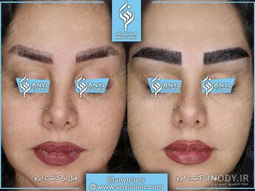 عکس کاشت ابرو طبیعی عکس کاشت ابرو طبیعی