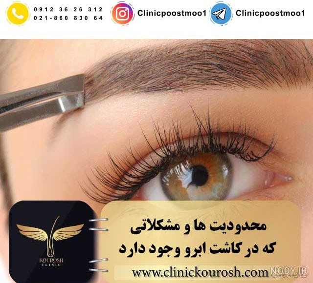 عکس کاشت ابرو نی نی سایت عکس کاشت ابرو نی نی سایت