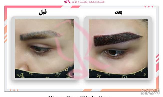 عکس کاشت ابرو کلینیک رز عکس کاشت ابرو کلینیک رز