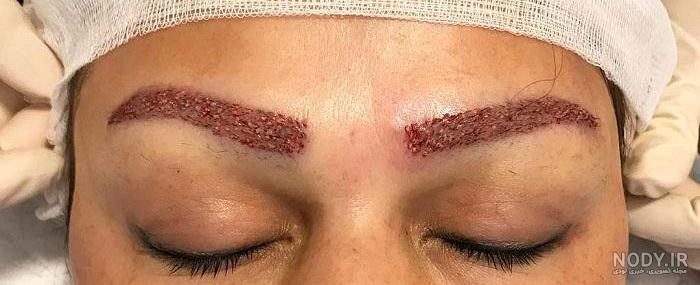 عکس کاشت ابروی طبیعی عکس کاشت ابروی طبیعی