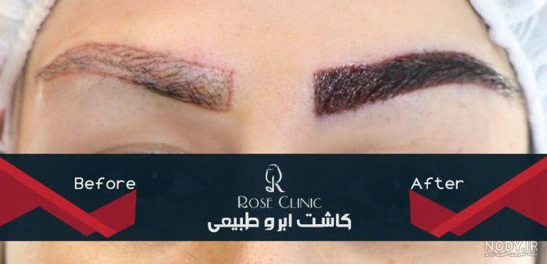 فیلم کاشت ابرو با جراحی فیلم کاشت ابرو با جراحی
