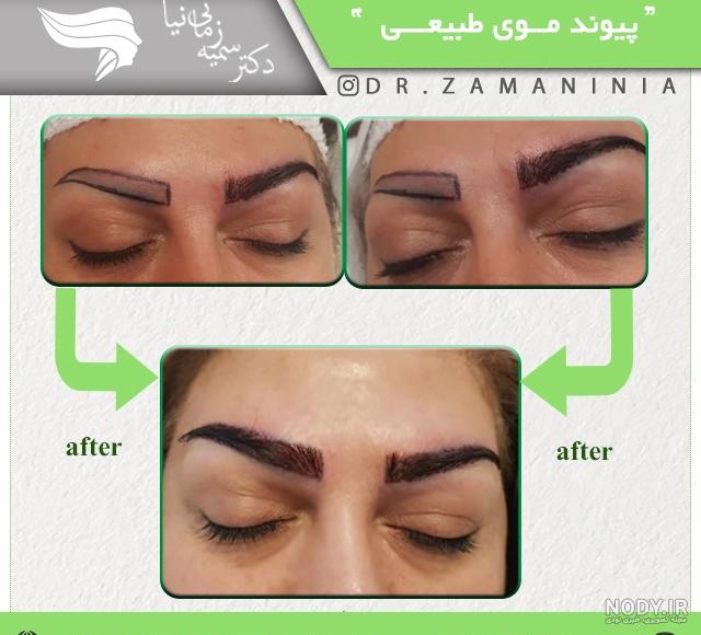 فیلم کاشت ابرو به روش sut فیلم کاشت ابرو به روش sut