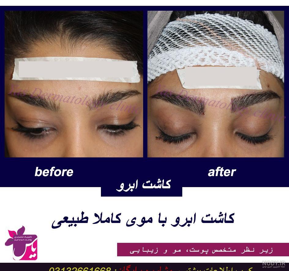 فیلم کاشت ابرو دائمی فیلم کاشت ابرو دائمی