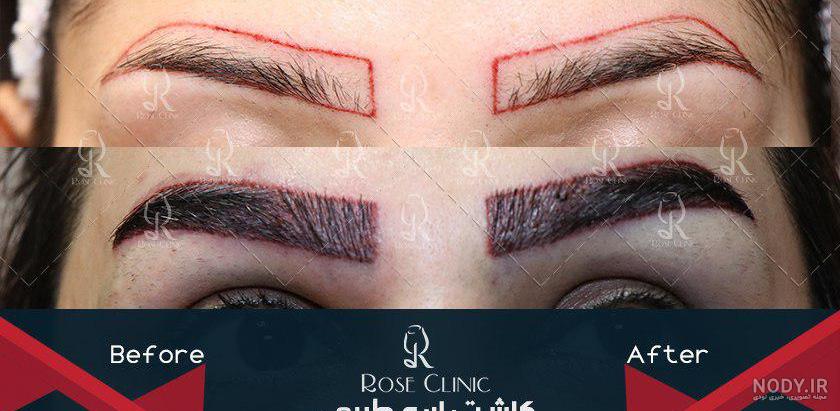 فیلم کاشت ابرو در کلینیک رز فیلم کاشت ابرو در کلینیک رز