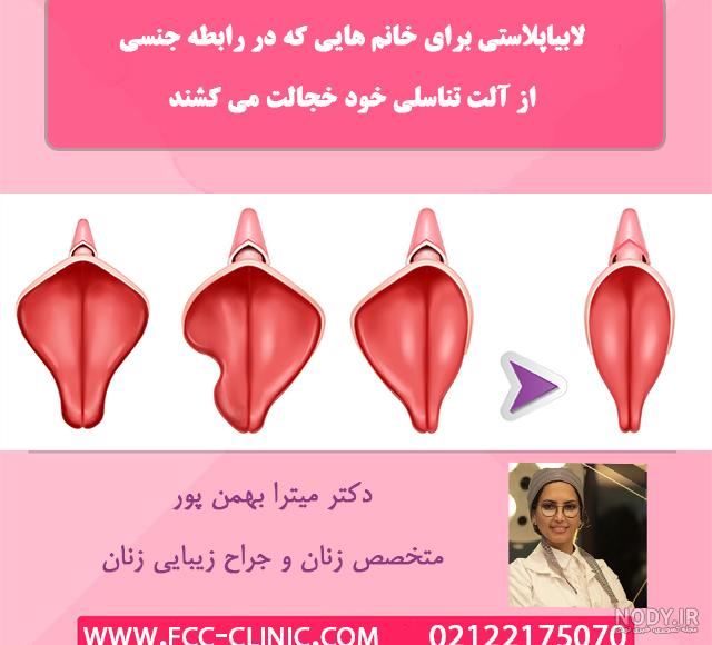 لابیاپلاستی عکس واقعی