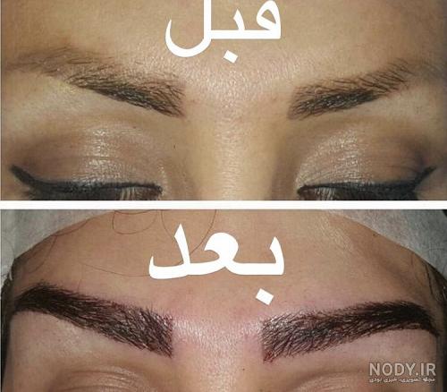 نتیجه کاشت ابرو بعد از سه ماه نتیجه کاشت ابرو بعد از سه ماه