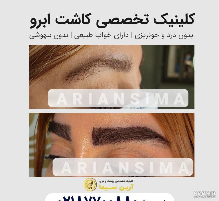کاشت ابرو بعد از,یک ماه کاشت ابرو بعد از,یک ماه