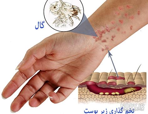 اسپری ضد گال اسپری ضد گال