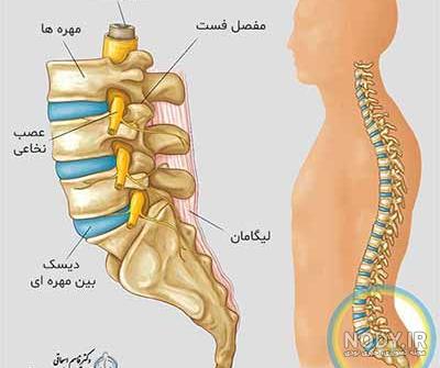 انواع جراحی پارگی دیسک کمر انواع جراحی پارگی دیسک کمر
