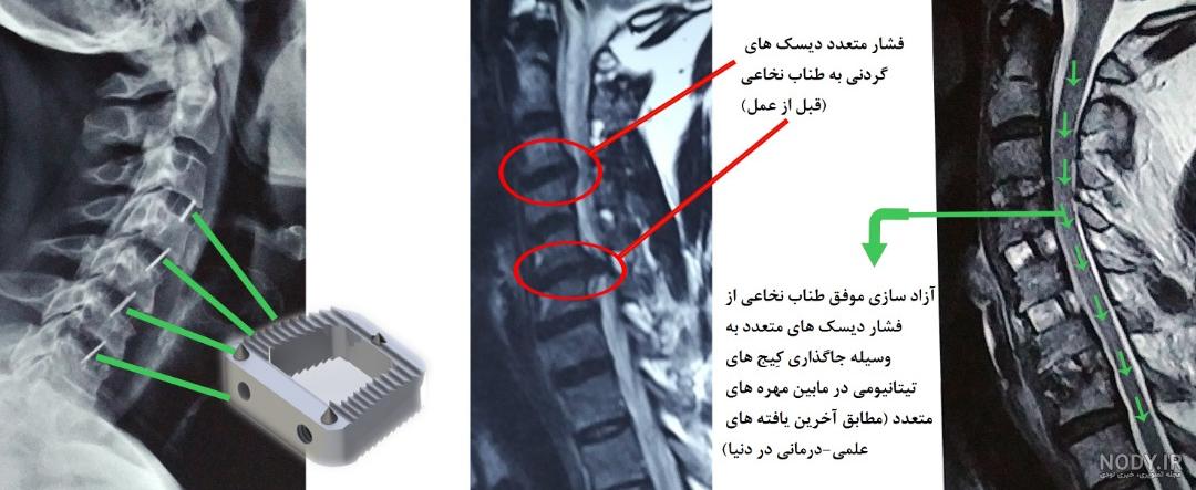 خطرناک ترین نوع دیسک کمر خطرناک ترین نوع دیسک کمر