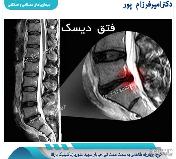درمان گیاهی پارگی دیسک کمر درمان گیاهی پارگی دیسک کمر