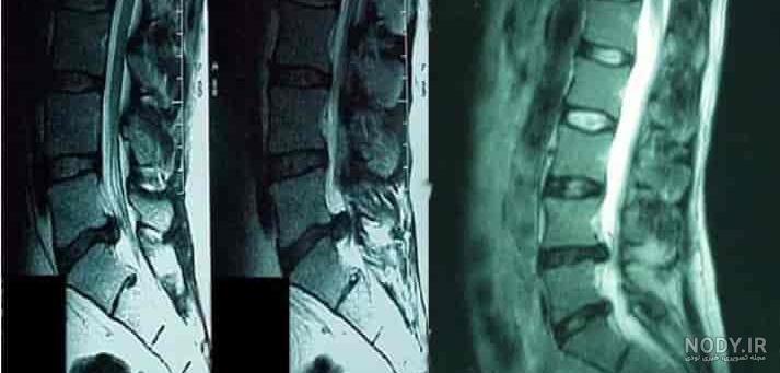 علائم پارگی دیسک کمر علائم پارگی دیسک کمر