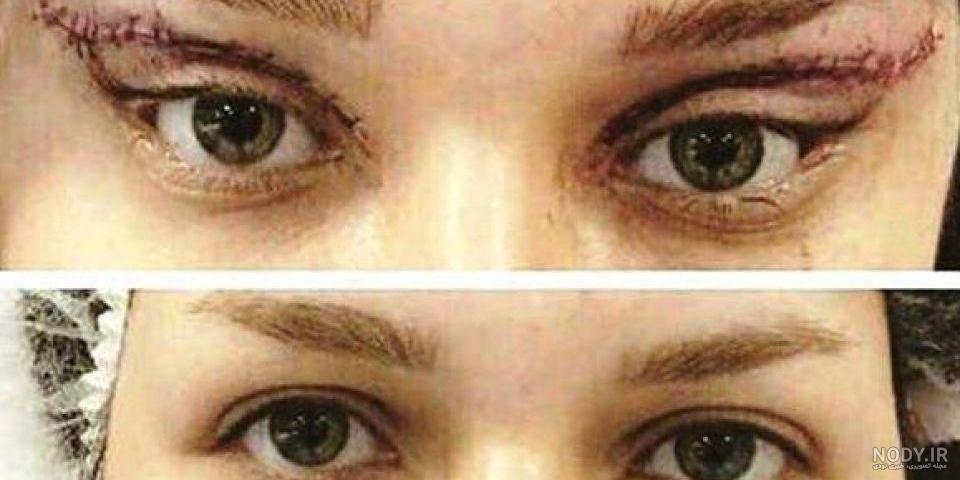 عمل چشم گربه ای بهنوش طباطبایی