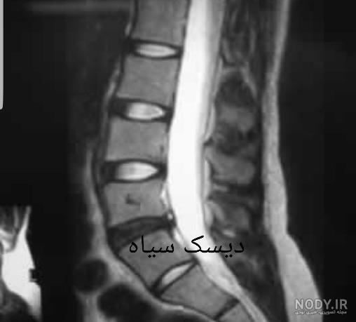 عکس دیسک کمر عکس دیسک کمر