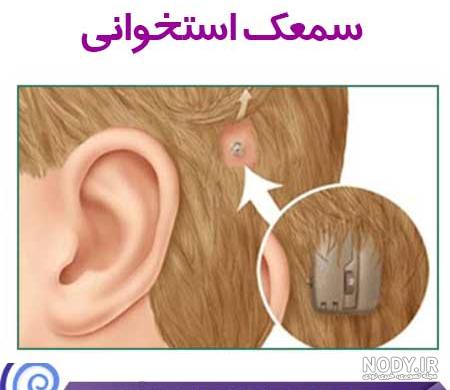 قیمت کویل دستگاه کاشت حلزون