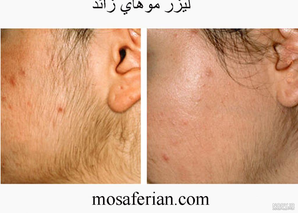 عکس لیزر بازی