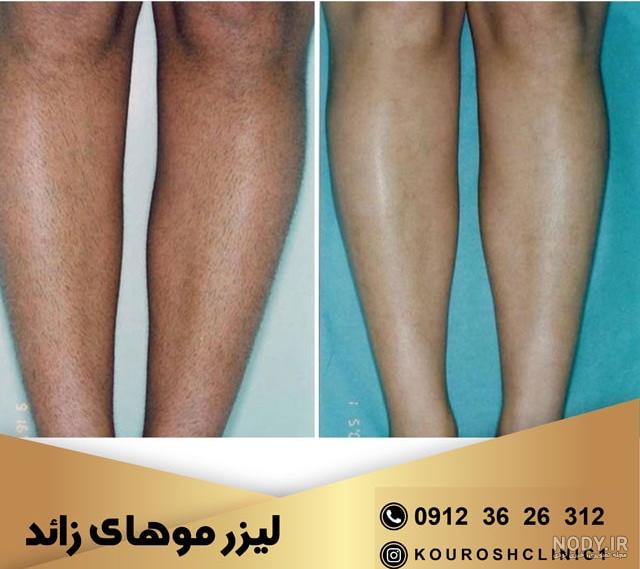 فیلم لیزر بدن اقایان
