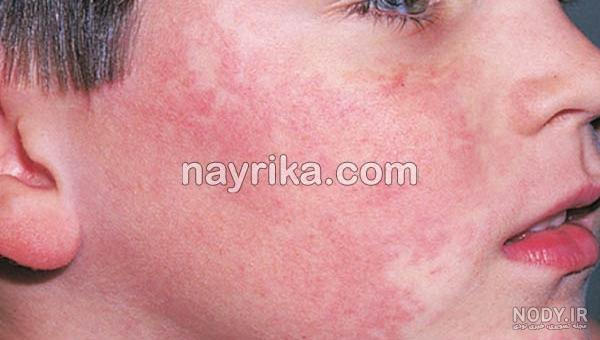 برای خارش مخملک چه کنیم