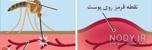 علائم مالاریا