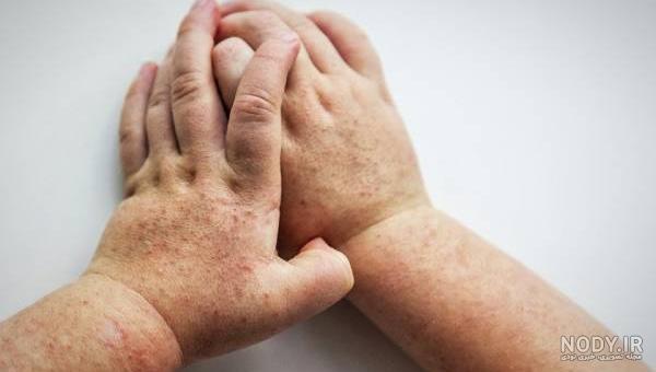 علت قرمز شدن زبان