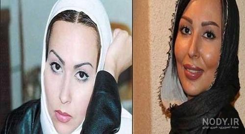عکس بازیگران ترکیه قبل و بعد از عمل زیبایی