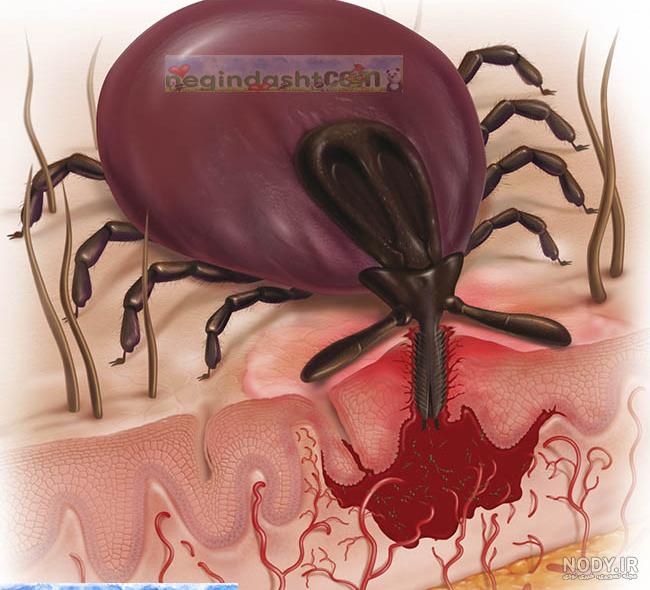 عکس جای گزیدگی کنه