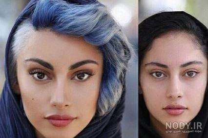 عکس های ترلان پروانه بعد از عمل بینی