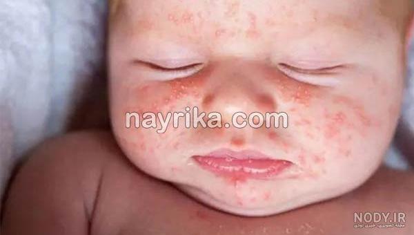 غذاهای مفید برای بیماری مخملک