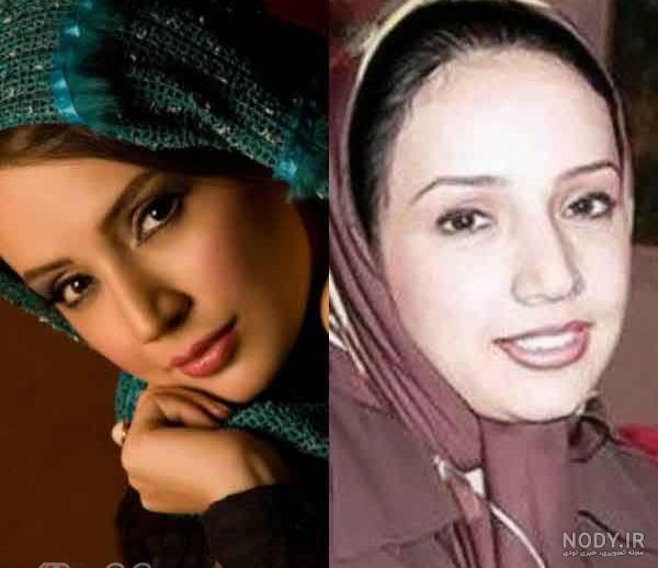 ترانه علیدوستی قبل از عمل بینی ترانه علیدوستی قبل از عمل بینی