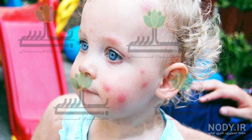 پماد هیدروکورتیزون برای نیش حشرات پماد هیدروکورتیزون برای نیش حشرات